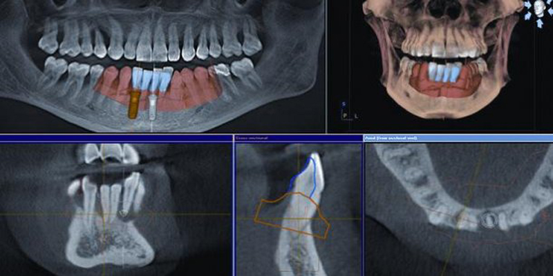 Ridge Preservation Grafting at PERFECT SMILE